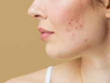 Effective Treatments for Acne & Pimple Management