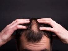 Say Goodbye to Hair Loss/Fall with Treatment
