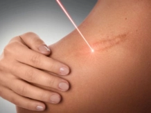 Say Goodbye to Scars with Treatment